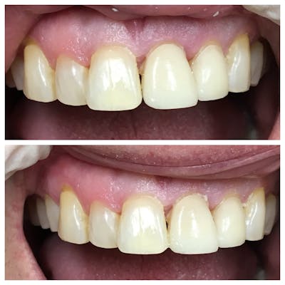 Crowns Before & After Gallery - Patient 86637823 - Image 1