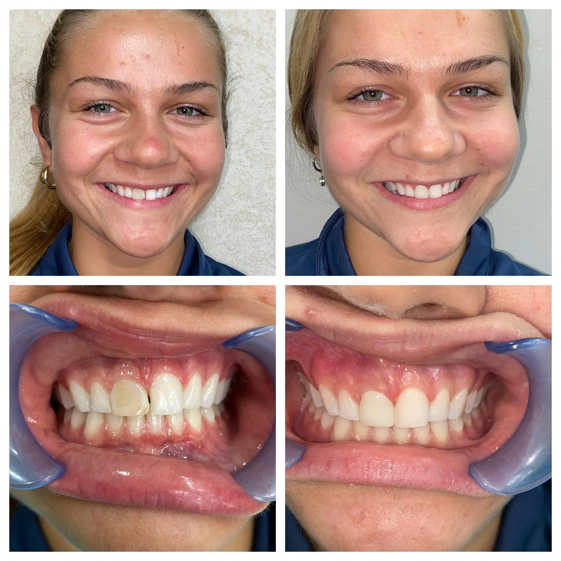 Crowns Before & After Gallery - Patient 86637824 - Image 1