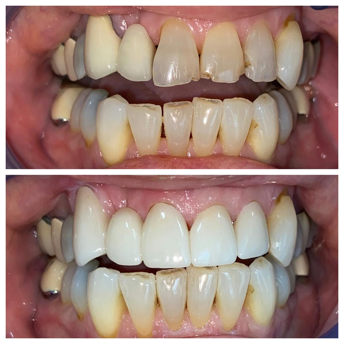 Crowns Before & After Gallery - Patient 86637825 - Image 1