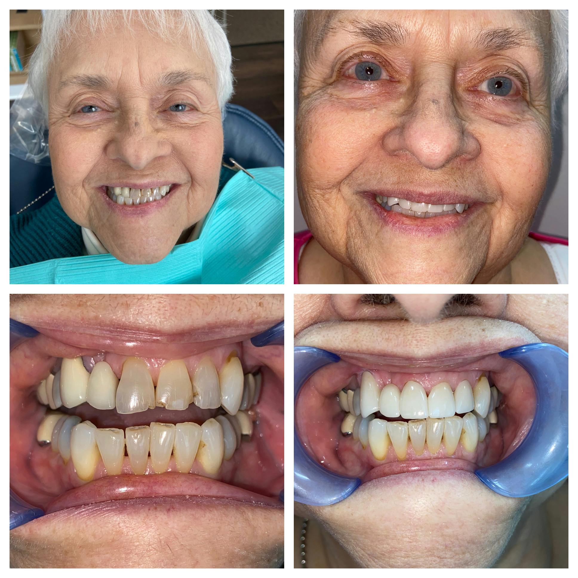Crowns Before & After Gallery - Patient 86637825 - Image 2