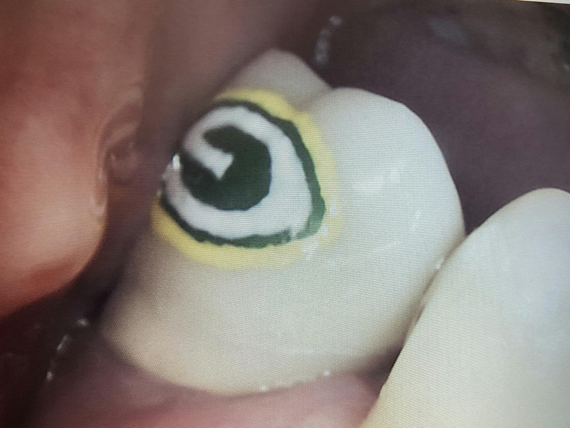 Dental Tattoos Before & After Gallery - Patient 95446613 - Image 1