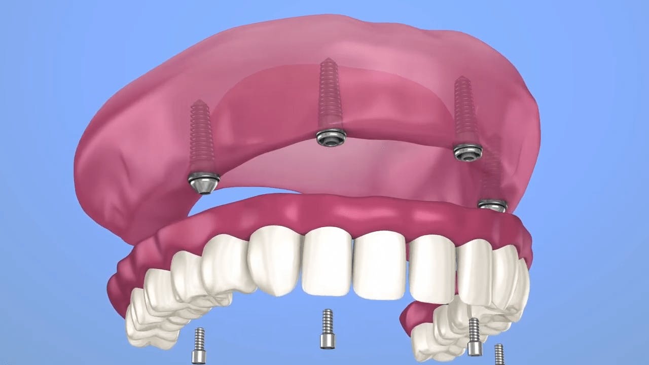 Implant diagram