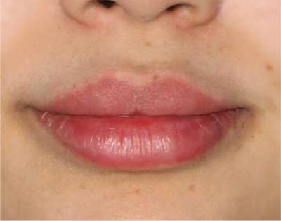 Dermal Fillers Before & After Gallery - Patient 133257037 - Image 2