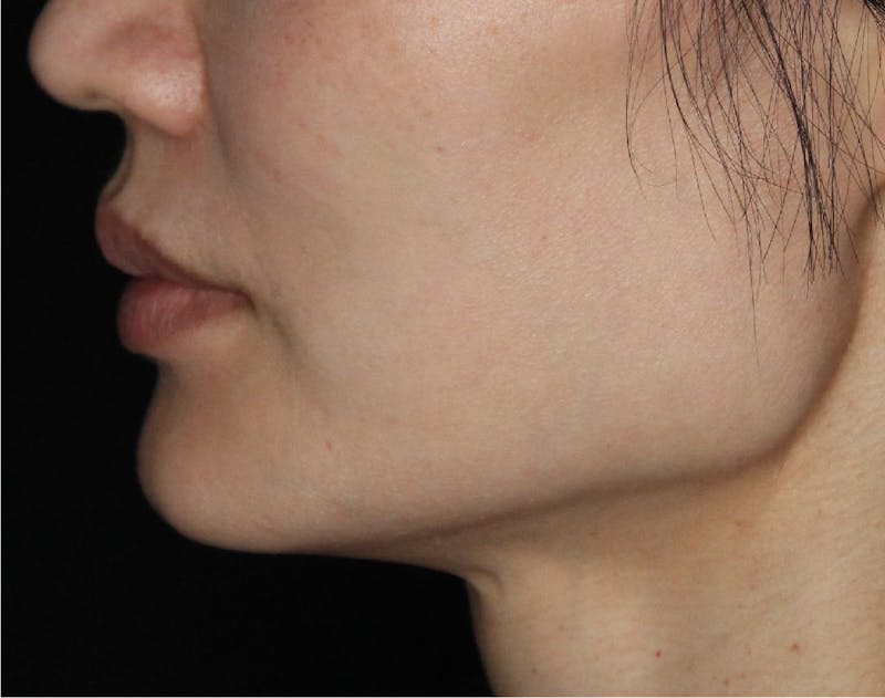 Dermal Fillers Before & After Gallery - Patient 133257038 - Image 1