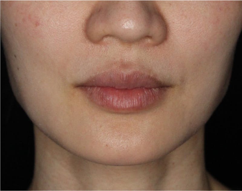 Dermal Fillers Before & After Gallery - Patient 133257038 - Image 3