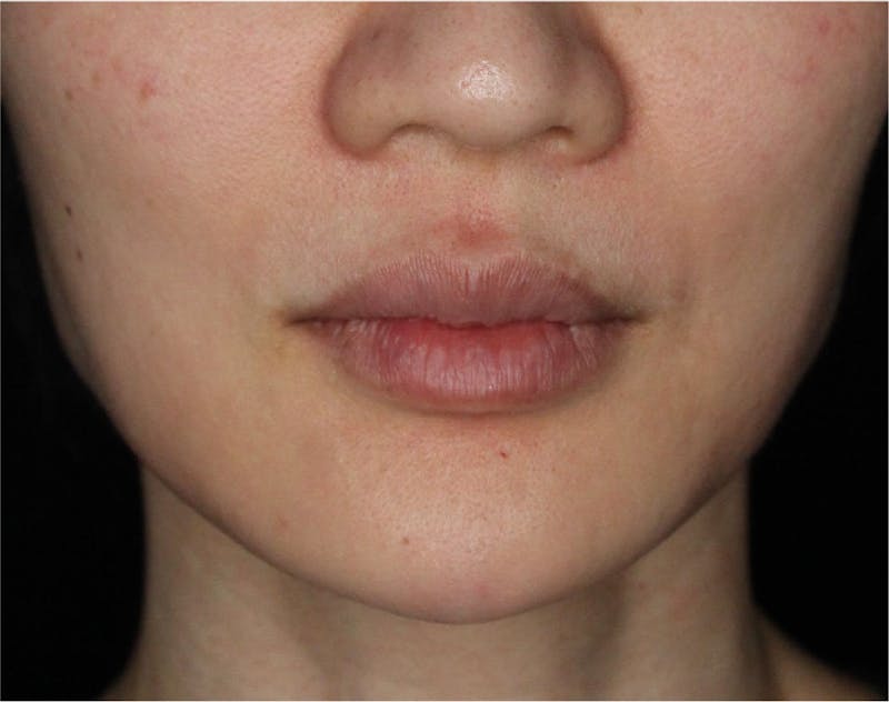 Dermal Fillers Before & After Gallery - Patient 133257038 - Image 4