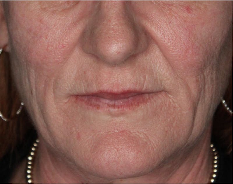 Dermal Fillers Before & After Gallery - Patient 133257040 - Image 5
