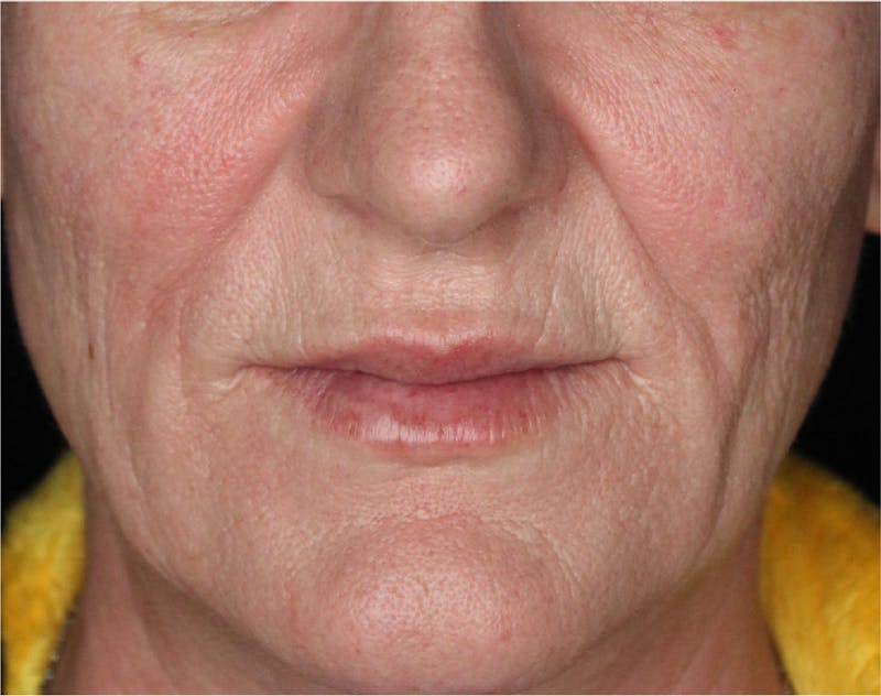 Dermal Fillers Before & After Gallery - Patient 133257040 - Image 6