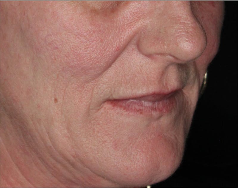 Dermal Fillers Before & After Gallery - Patient 133257040 - Image 3