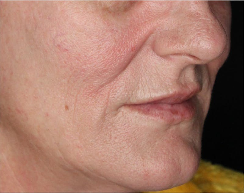 Dermal Fillers Before & After Gallery - Patient 133257040 - Image 4
