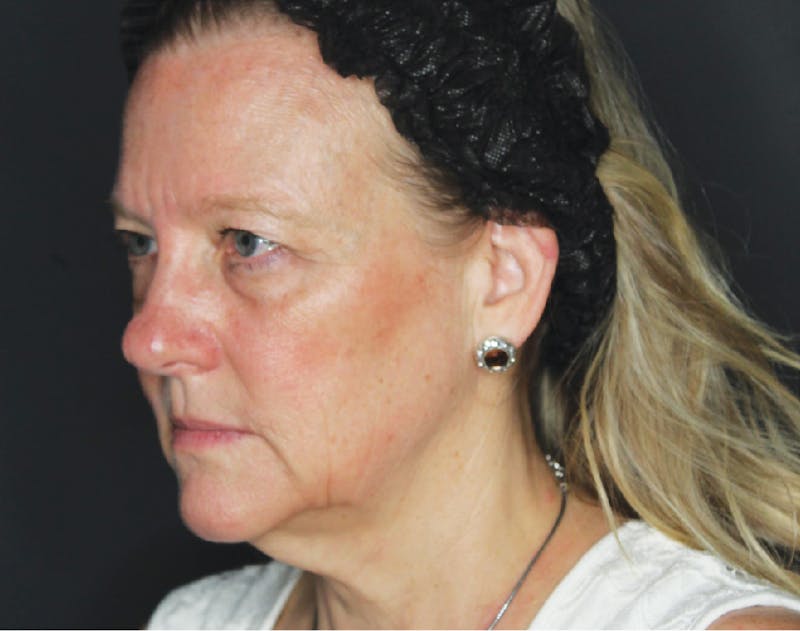 Facelift & Neck Lift Before & After Gallery - Patient 89304770 - Image 1