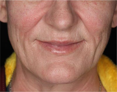 Dermal Fillers Before & After Gallery - Patient 133257040 - Image 2