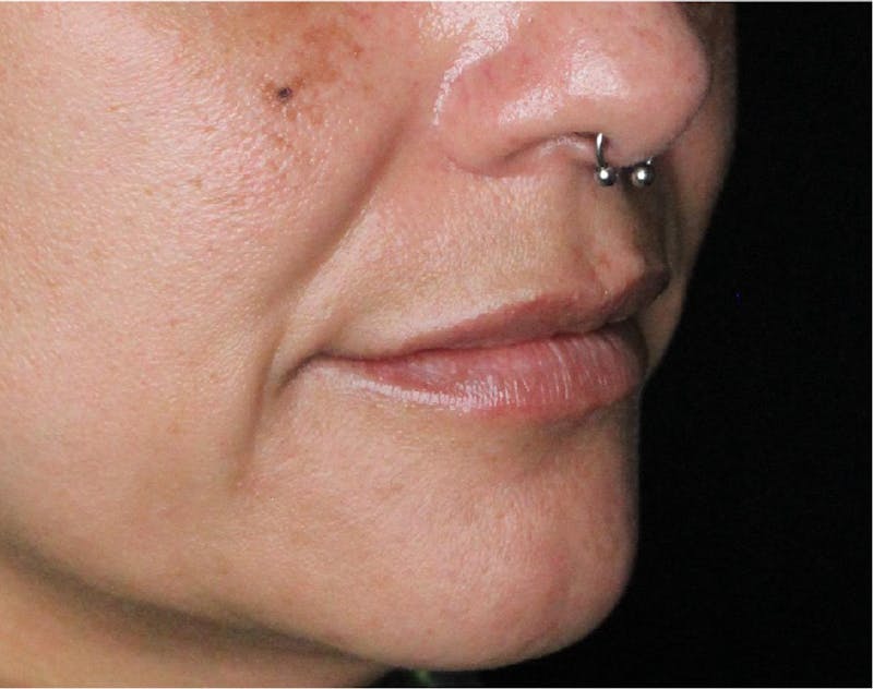 Dermal Fillers Before & After Gallery - Patient 133257041 - Image 1
