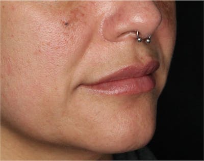 Dermal Fillers Before & After Gallery - Patient 133257041 - Image 2