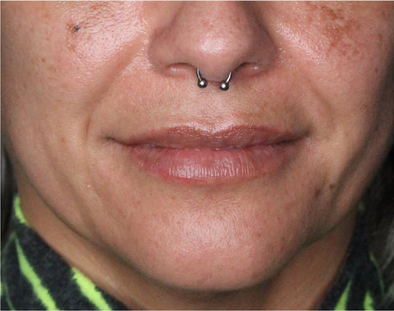 Dermal Fillers Before & After Gallery - Patient 133257041 - Image 3