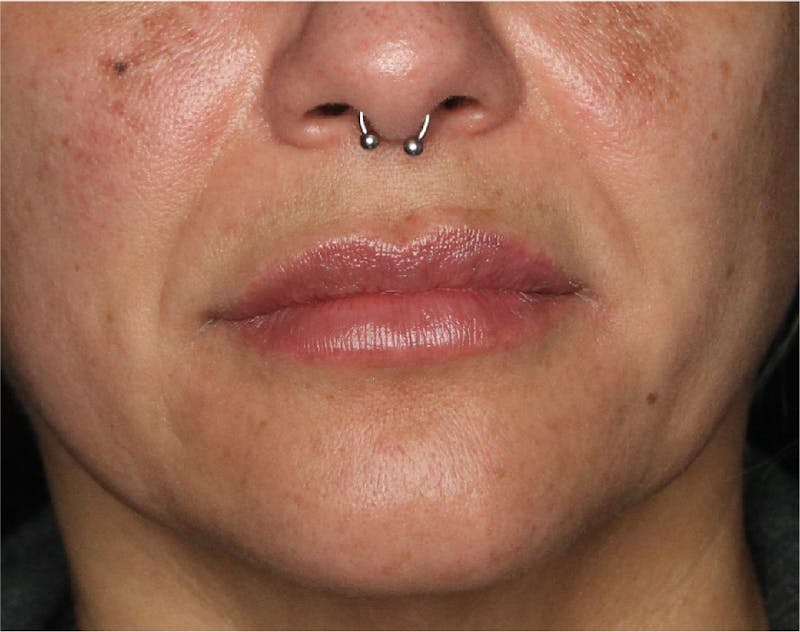 Dermal Fillers Before & After Gallery - Patient 133257041 - Image 4