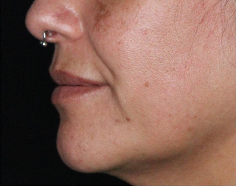 Dermal Fillers Before & After Gallery - Patient 133257041 - Image 5