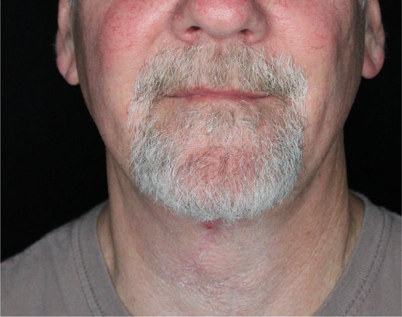 Facelift & Neck Lift Before & After Gallery - Patient 89306863 - Image 4