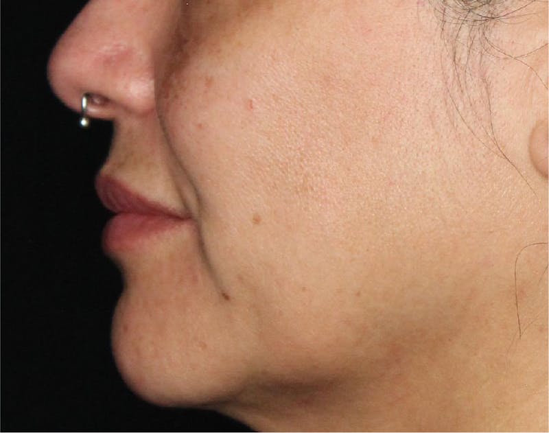 Dermal Fillers Before & After Gallery - Patient 133257041 - Image 6