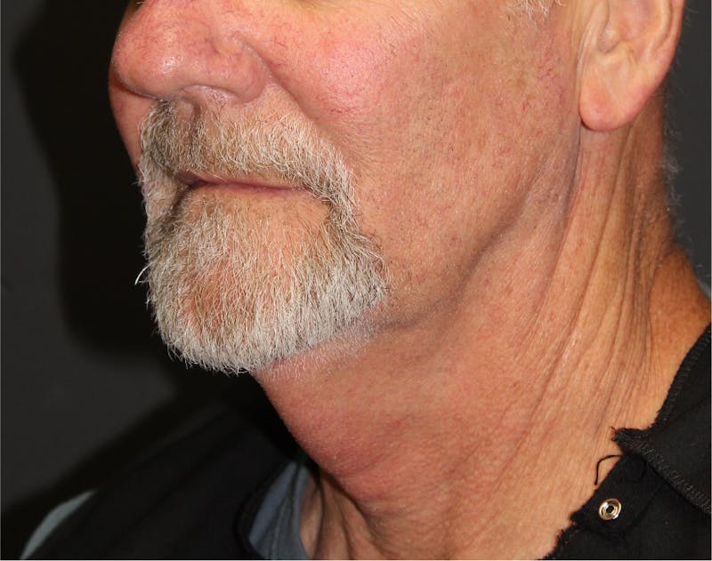 Facelift & Neck Lift Before & After Gallery - Patient 89306863 - Image 5