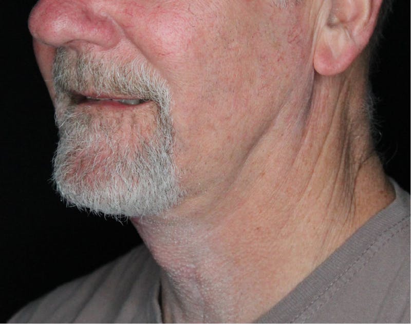 Facelift & Neck Lift Before & After Gallery - Patient 89306863 - Image 6