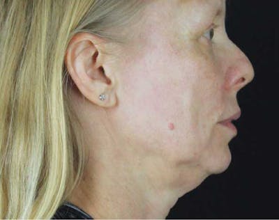 Facelift & Neck Lift Before & After Gallery - Patient 89306871 - Image 1