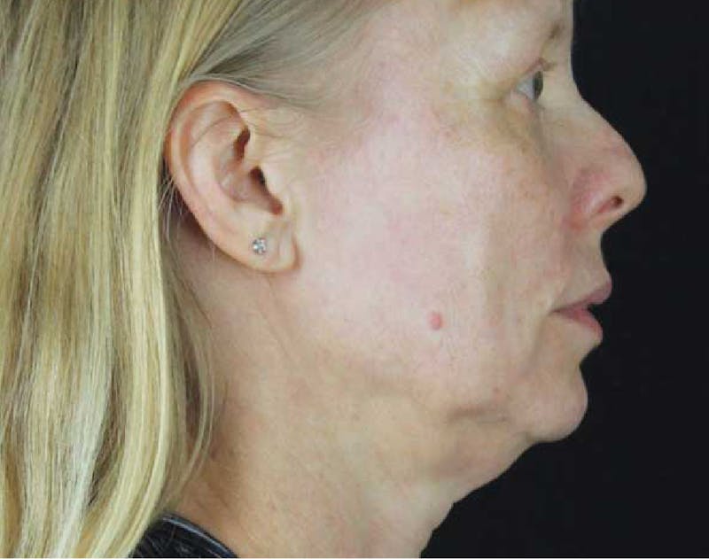 Facelift & Neck Lift Before & After Gallery - Patient 89306871 - Image 1