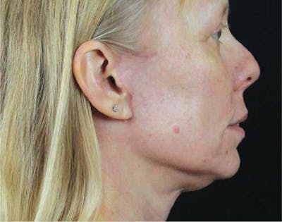 Facelift & Neck Lift Before & After Gallery - Patient 89306871 - Image 2