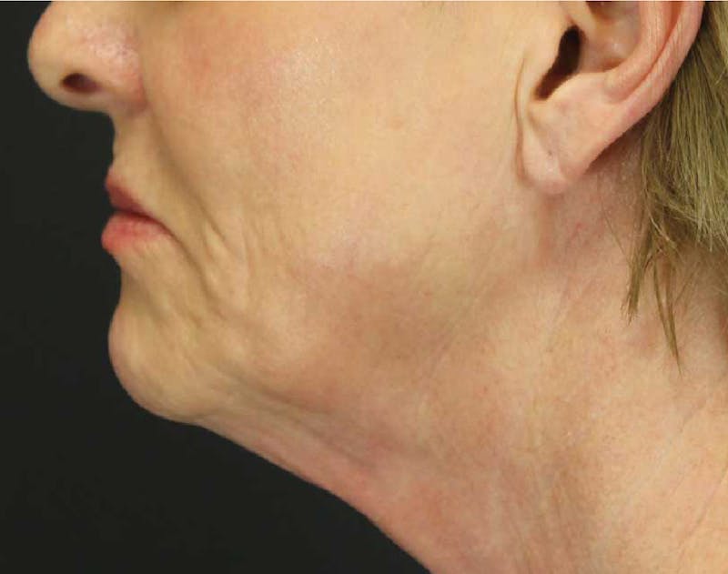 Facelift & Neck Lift Before & After Gallery - Patient 89312966 - Image 1