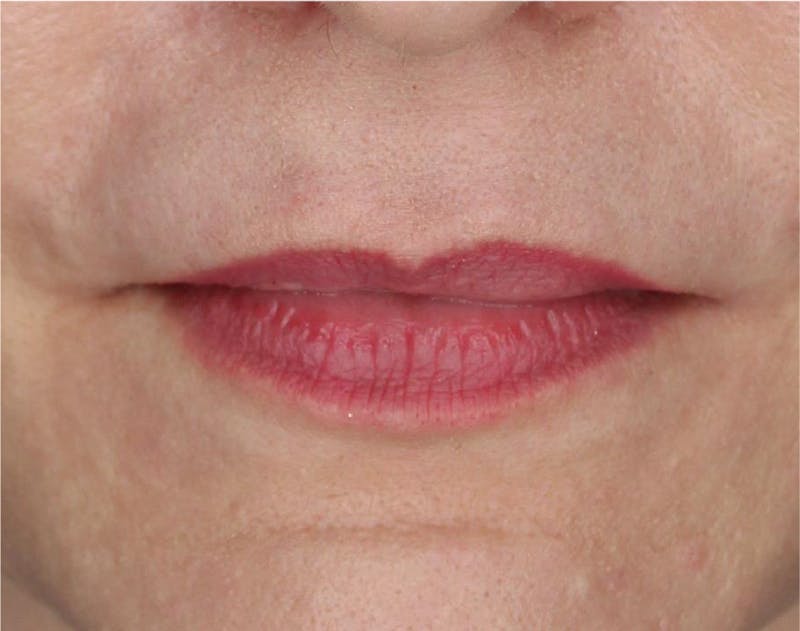 Lip Lift Before & After Gallery - Patient 89312967 - Image 1