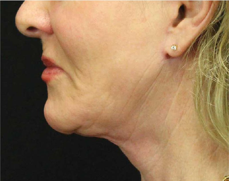 Facelift & Neck Lift Before & After Gallery - Patient 89312966 - Image 2