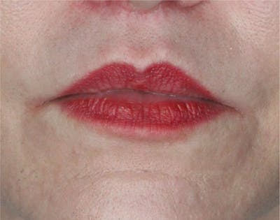 Lip Lift Before & After Gallery - Patient 89312967 - Image 2