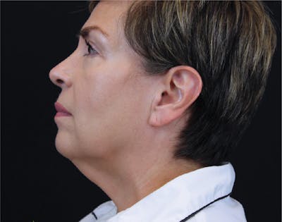 Facelift & Neck Lift Before & After Gallery - Patient 89312971 - Image 1