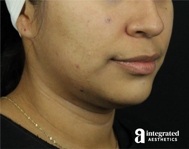 Lip Lift Before & After Gallery - Patient 89319068 - Image 1