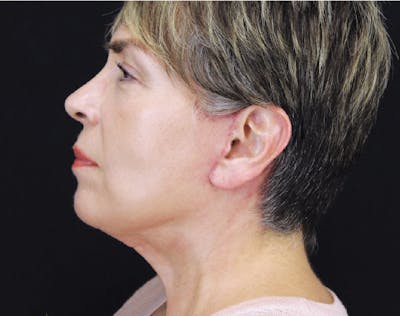 Facelift & Neck Lift Before & After Gallery - Patient 89312971 - Image 2