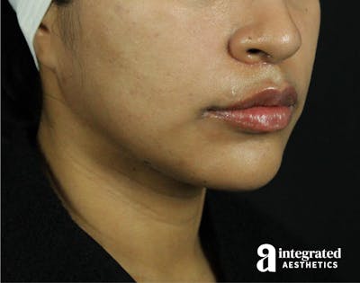 Lip Lift Before & After Gallery - Patient 89319068 - Image 2