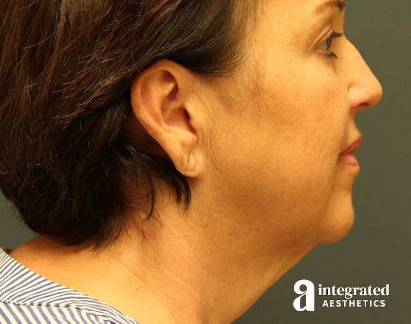 Facelift & Neck Lift Before & After Gallery - Patient 89319062 - Image 1