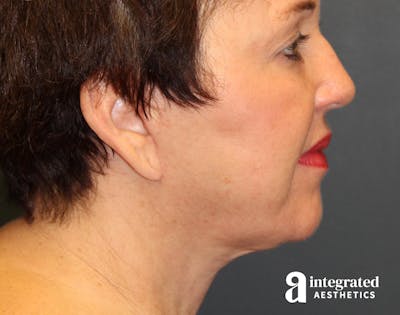 Facelift & Neck Lift Before & After Gallery - Patient 89319062 - Image 2