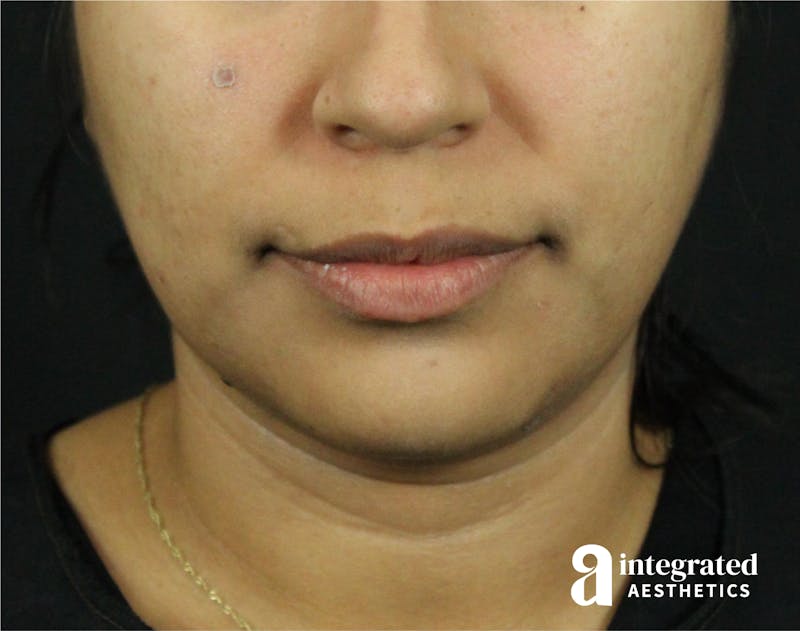 Lip Lift Before & After Gallery - Patient 89319068 - Image 3