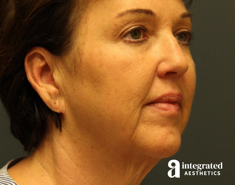 Facelift & Neck Lift Before & After Gallery - Patient 89319062 - Image 3