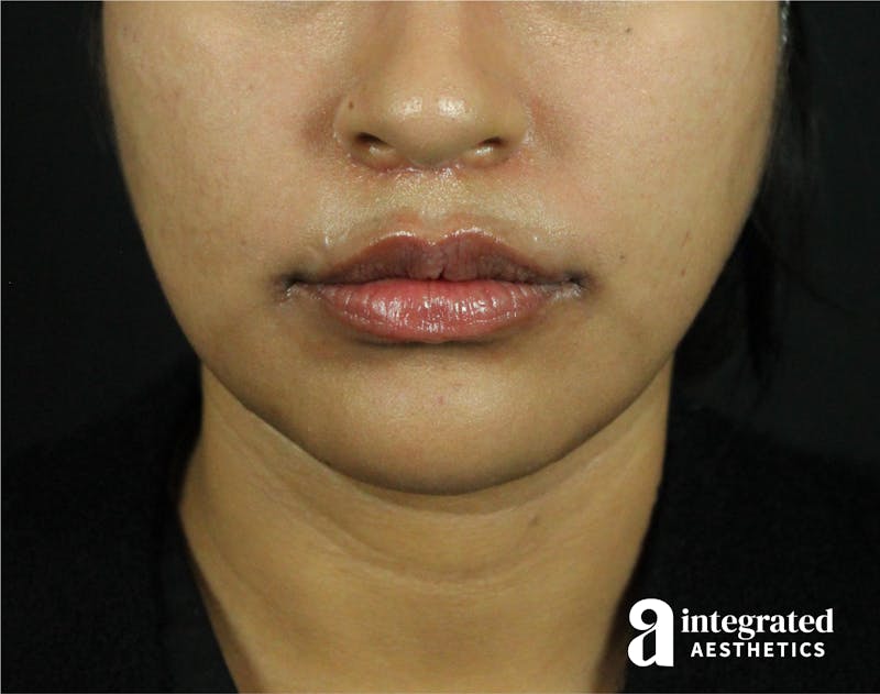 Lip Lift Before & After Gallery - Patient 89319068 - Image 4