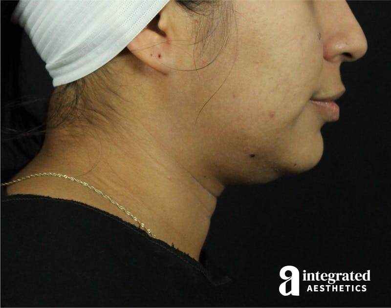 Lip Lift Before & After Gallery - Patient 89319068 - Image 5
