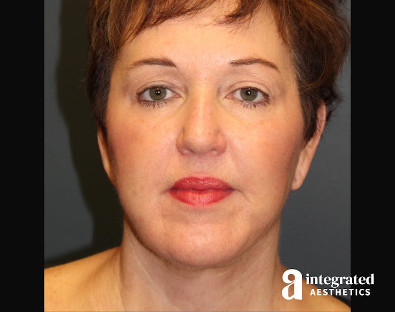 Facelift & Neck Lift Before & After Gallery - Patient 89319062 - Image 6