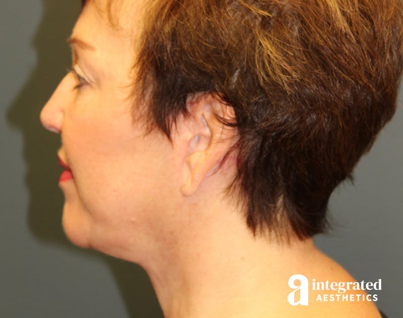 Facelift & Neck Lift Before & After Gallery - Patient 89319062 - Image 8