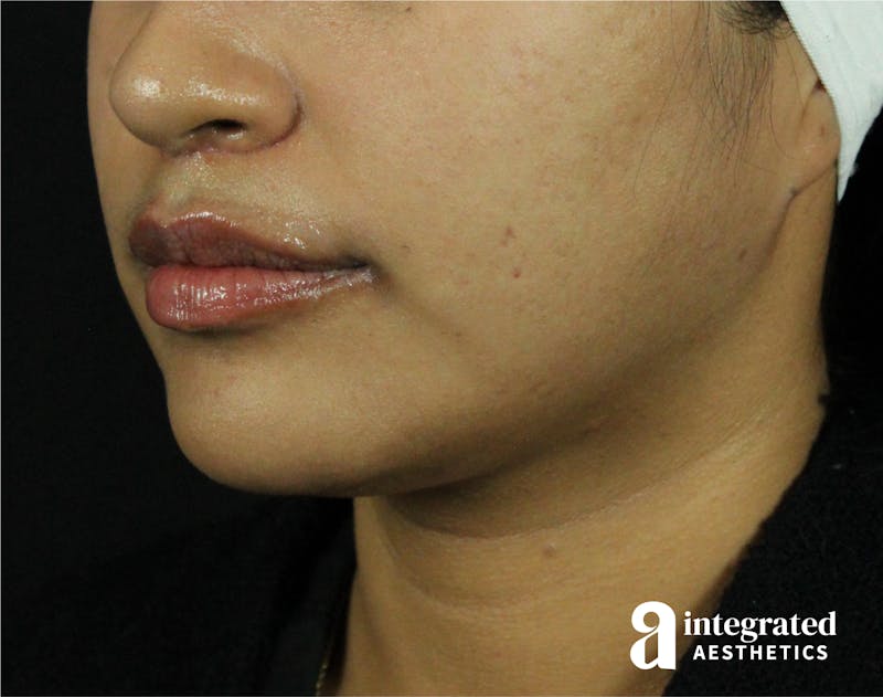 Lip Lift Before & After Gallery - Patient 89319068 - Image 8