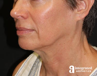 Facelift & Neck Lift Before & After Gallery - Patient 89325157 - Image 1