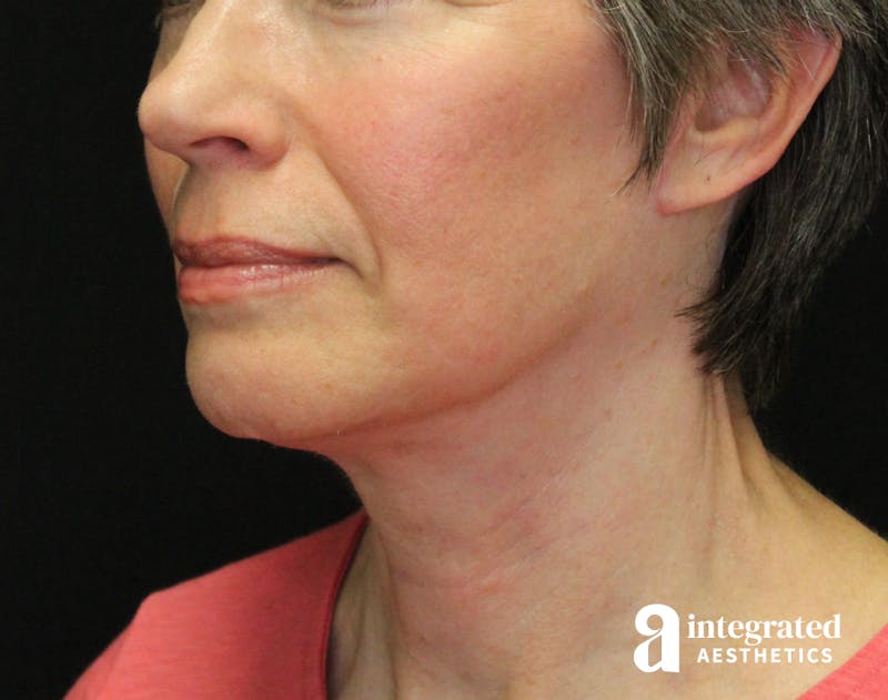 Facelift & Neck Lift Before & After Gallery - Patient 89325157 - Image 2