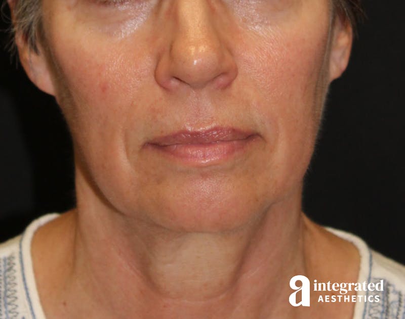 Facelift & Neck Lift Before & After Gallery - Patient 89325157 - Image 3