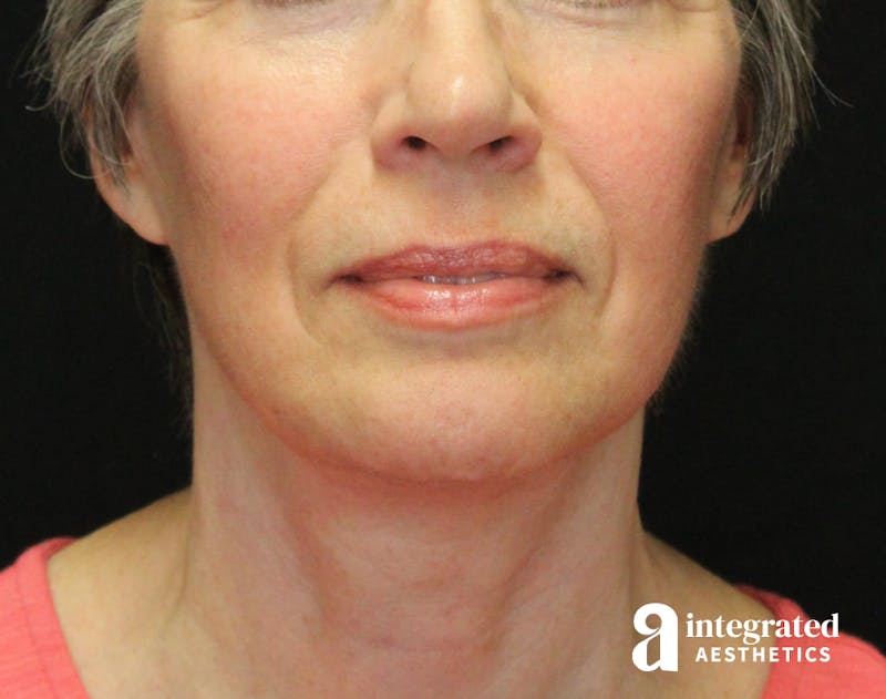 Facelift & Neck Lift Before & After Gallery - Patient 89325157 - Image 4