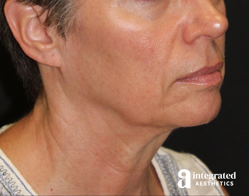 Facelift & Neck Lift Before & After Gallery - Patient 89325157 - Image 5